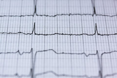Grafische Darstellung einer EKG-Kurve zur präzisen Herzanalyse im Rahmen der Sportkardiologie und des Manager-Check-ups in der Praxis Augsburg.